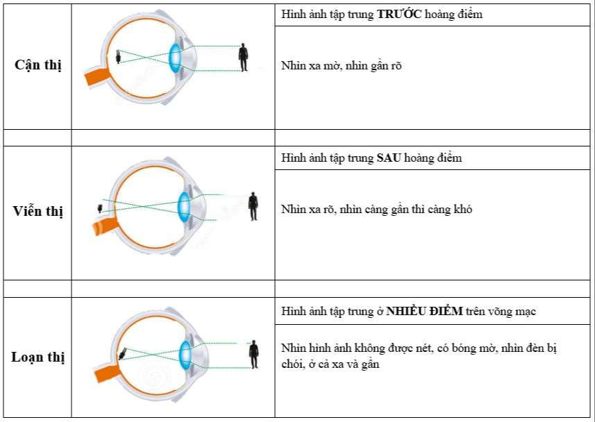 tầm soát tật khúc xạ