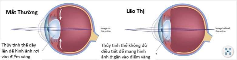 tầm soát tật khúc xạ